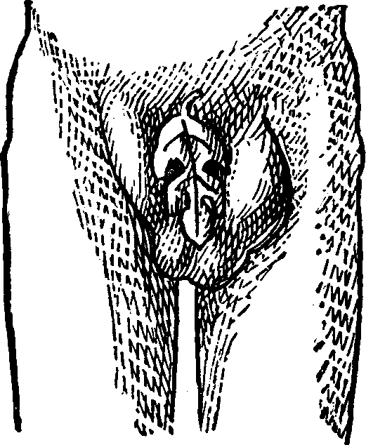 Illustration:
Fig. 5. This figure illustrates a Double Inguinal Hernia